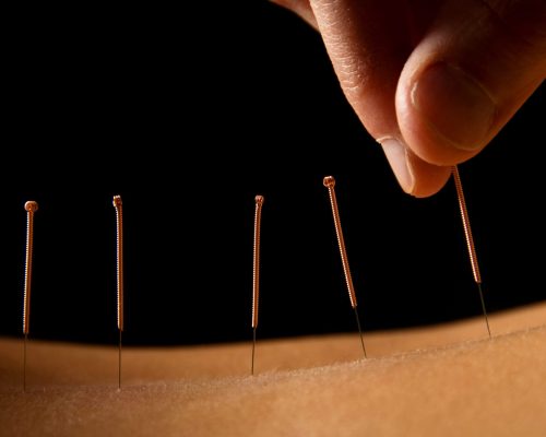 Acupuncture Needles inserted in the Back for Treatment